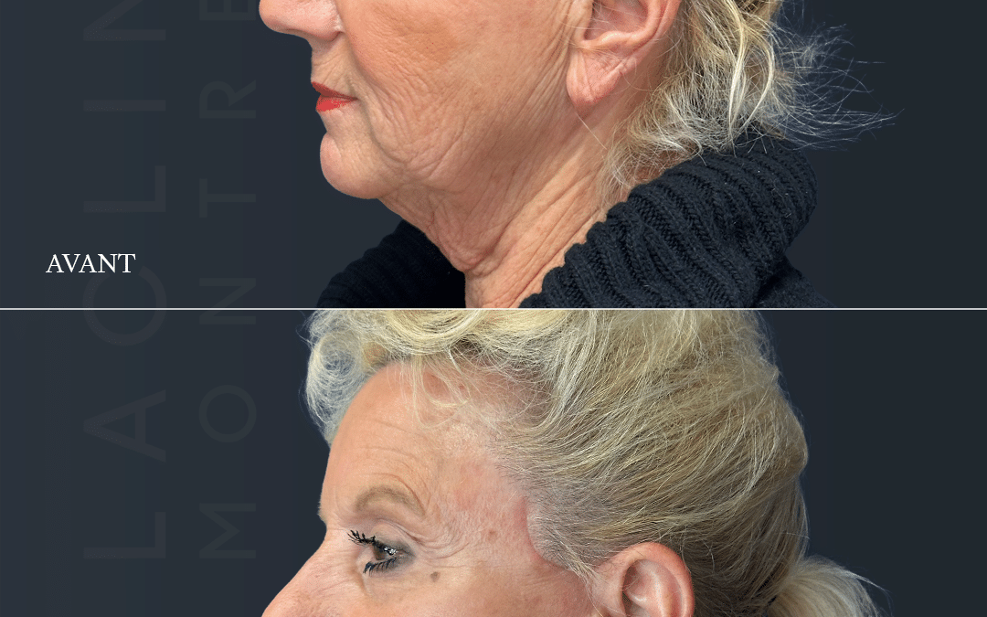 Lifting visage