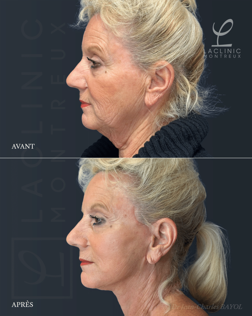 Lifting visage, deep-plane facelift