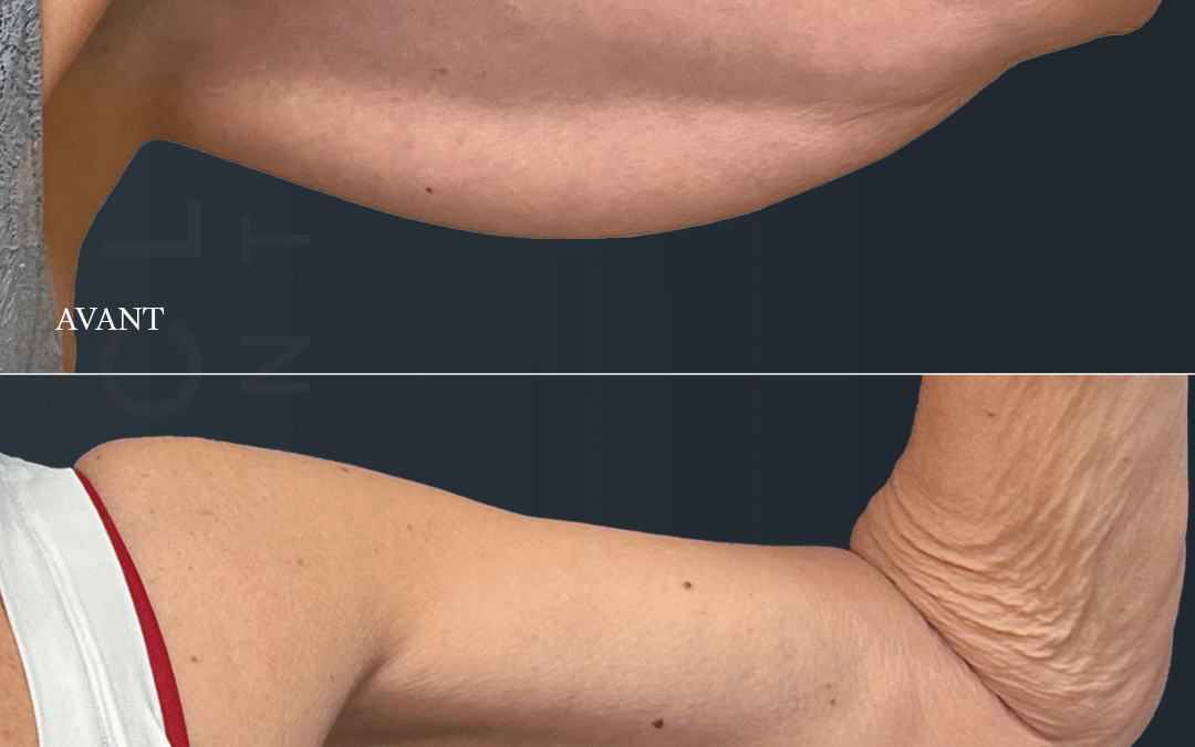 Brachioplastie