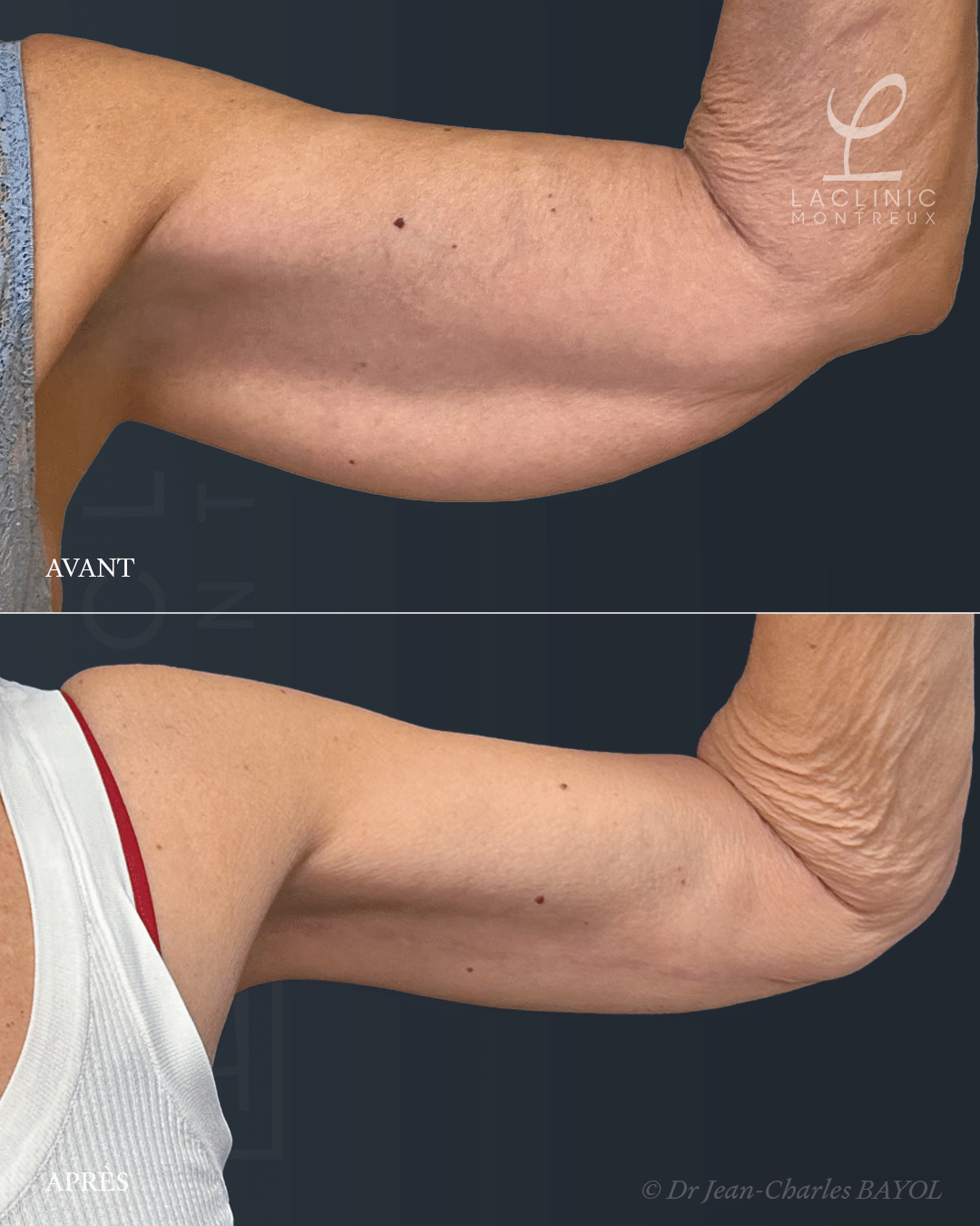 Brachioplastie, lifting des bras, chirurgie esthétique des bras