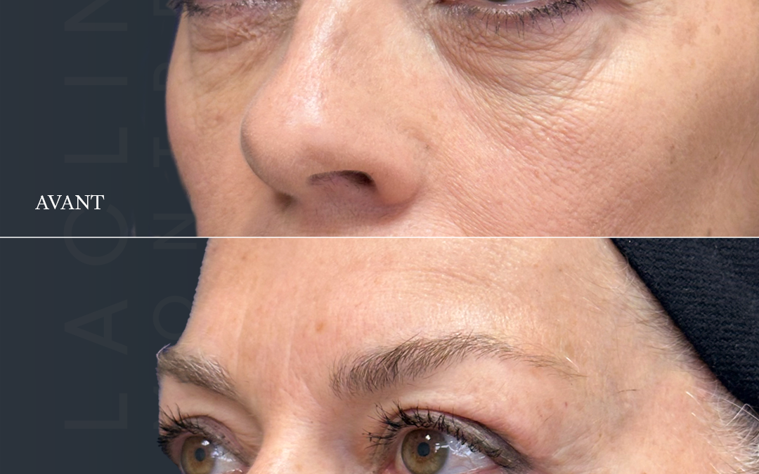 Blépharoplastie