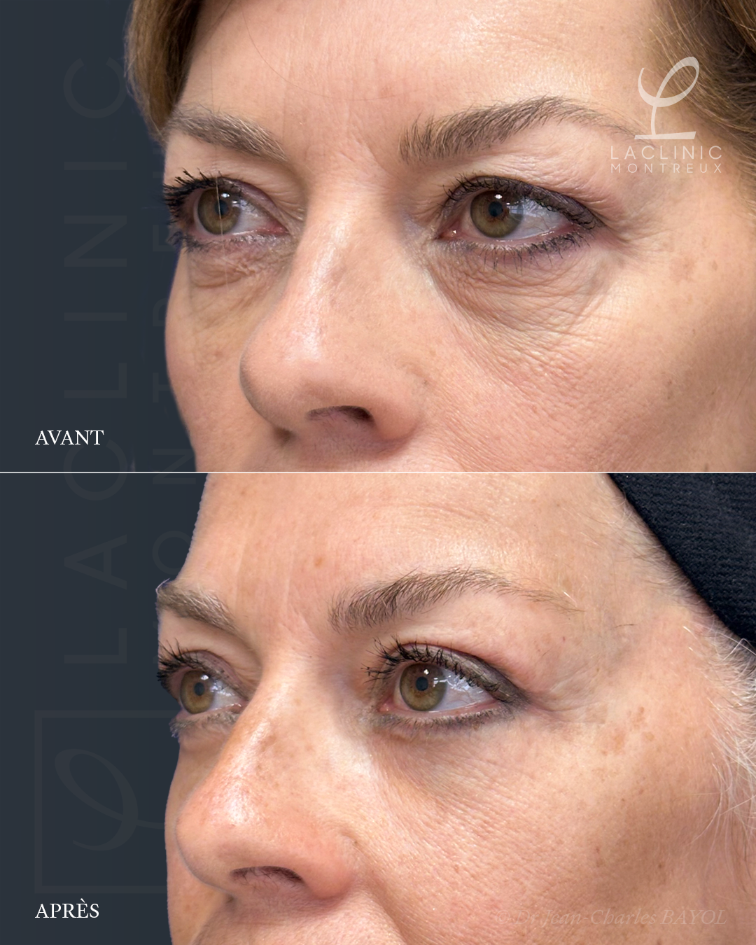 Blépharoplastie infrieure pour retirer les poches sous les yeux