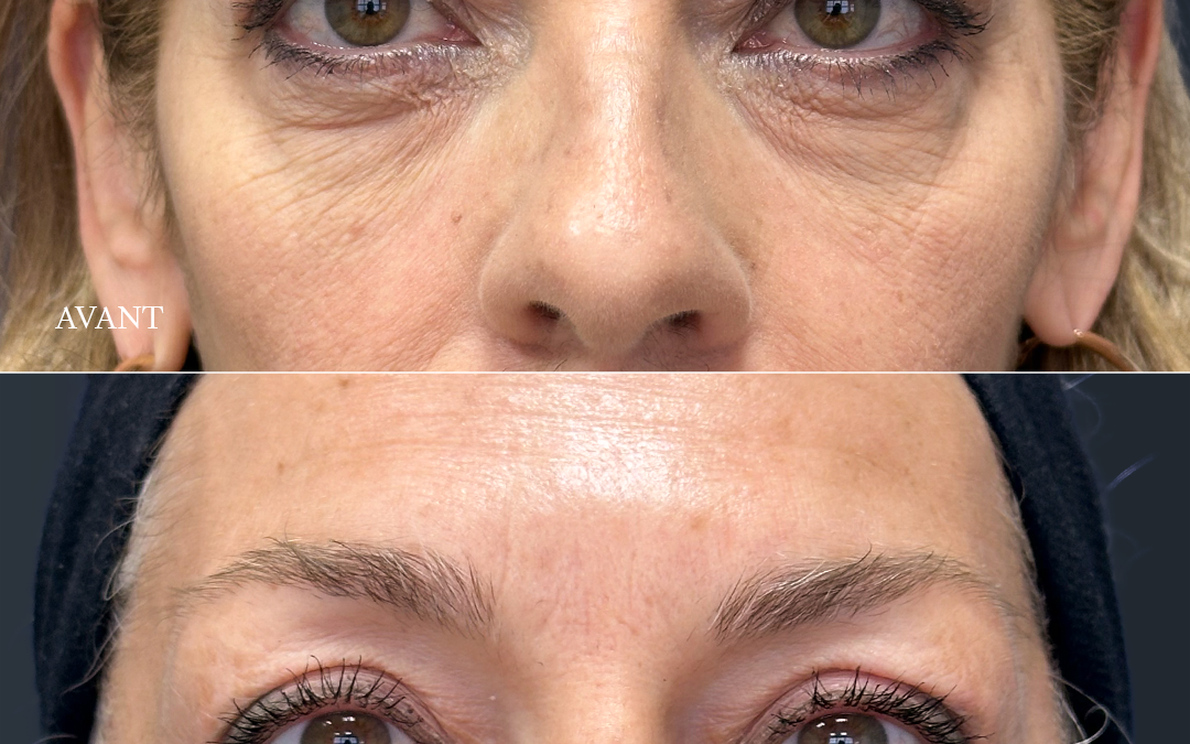 Blépharoplastie