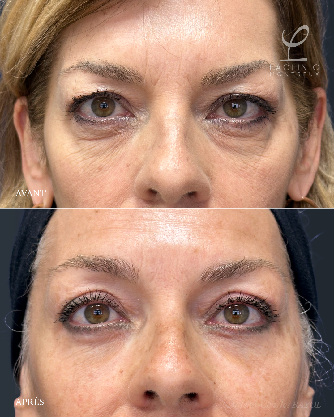 Blépharoplastie infrieure pour retirer les poches sous les yeux