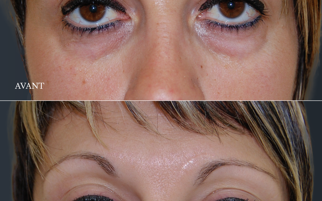 Blépharoplastie