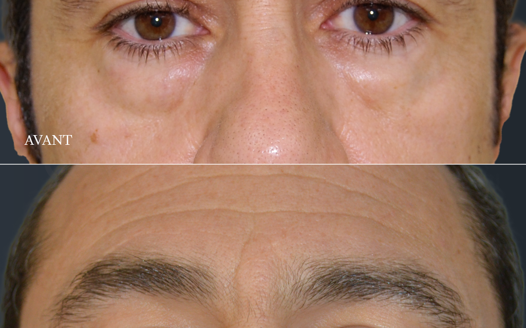 Blépharoplastie