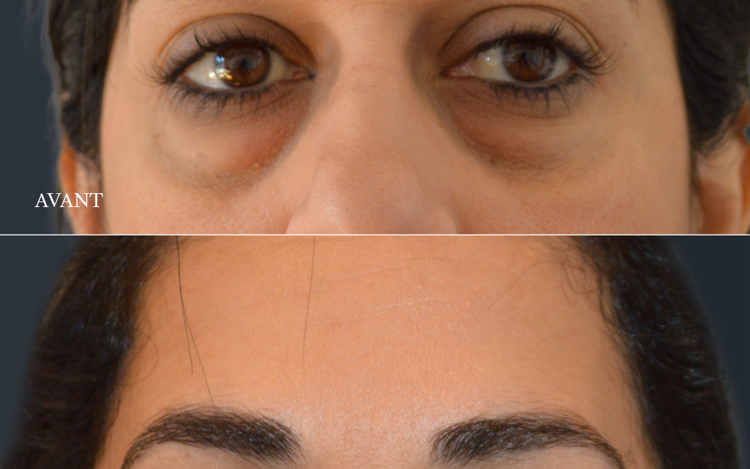 Blépharoplastie