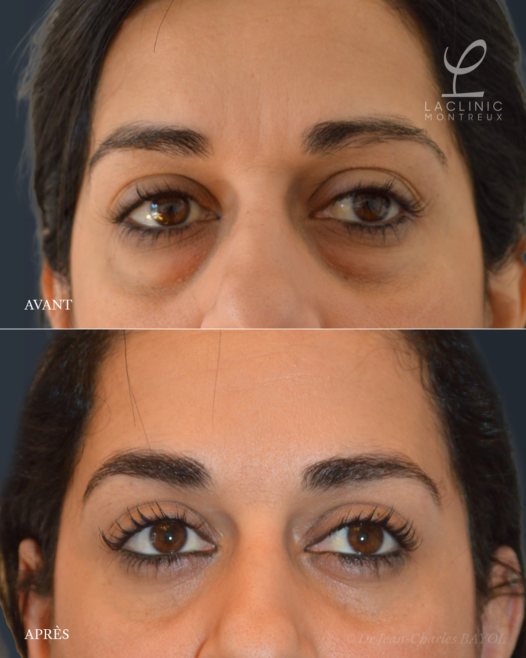Blépharoplastie infrieure pour retirer les poches sous les yeux