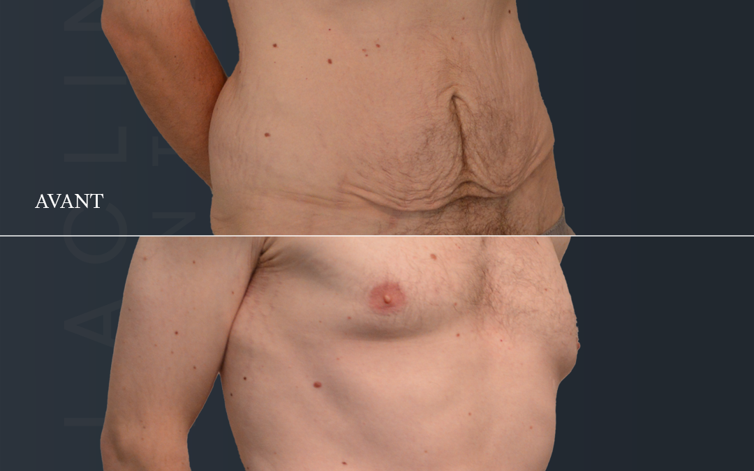 Bodylift