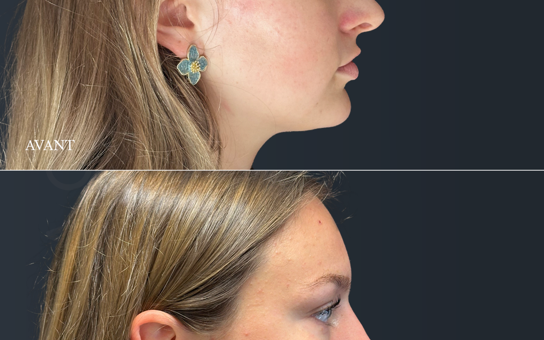 Rhinoplastie