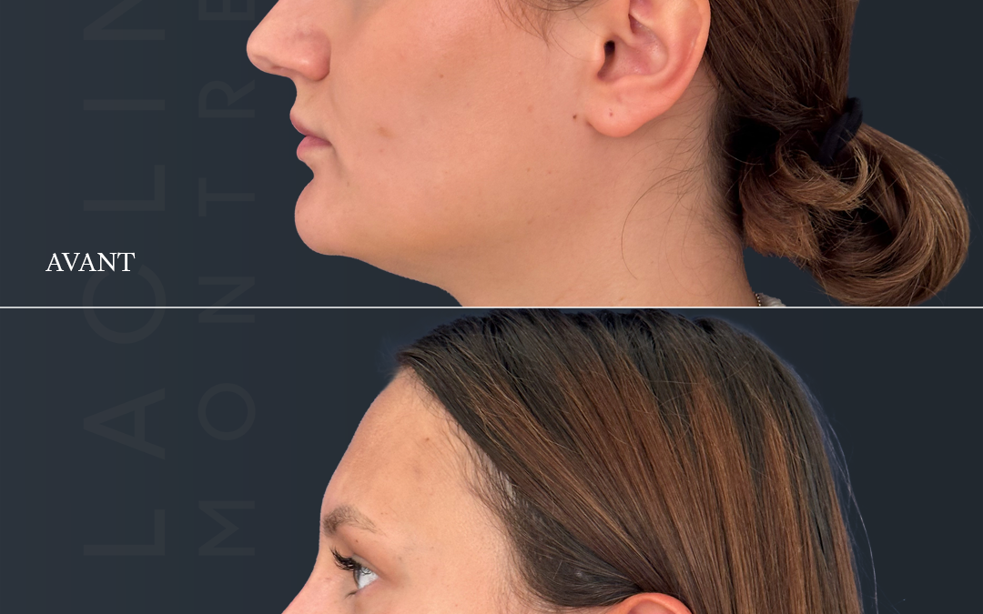 Rhinoplastie