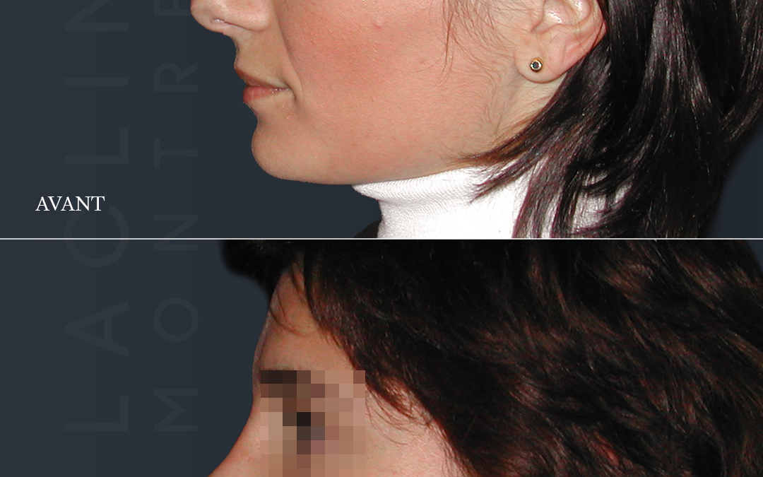 Rhinoplastie