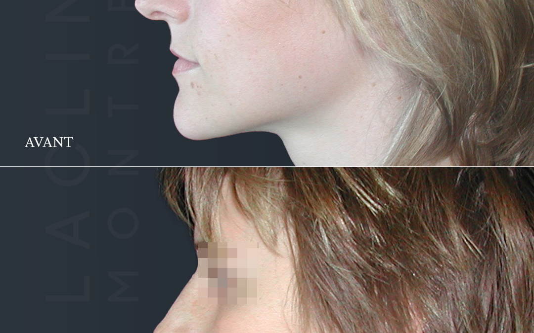 Rhinoplastie