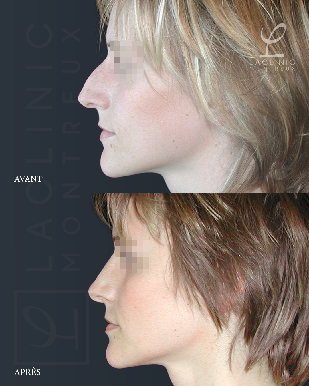 Avant-après rhinoplastie chirurgie esthétique du nez
