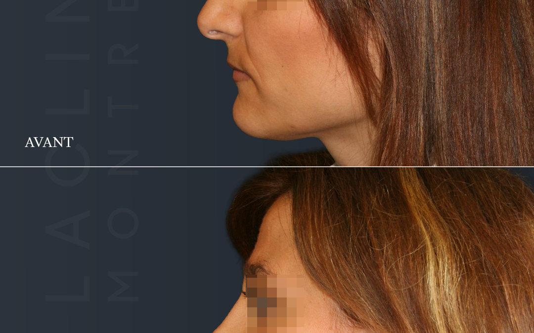 Rhinoplastie