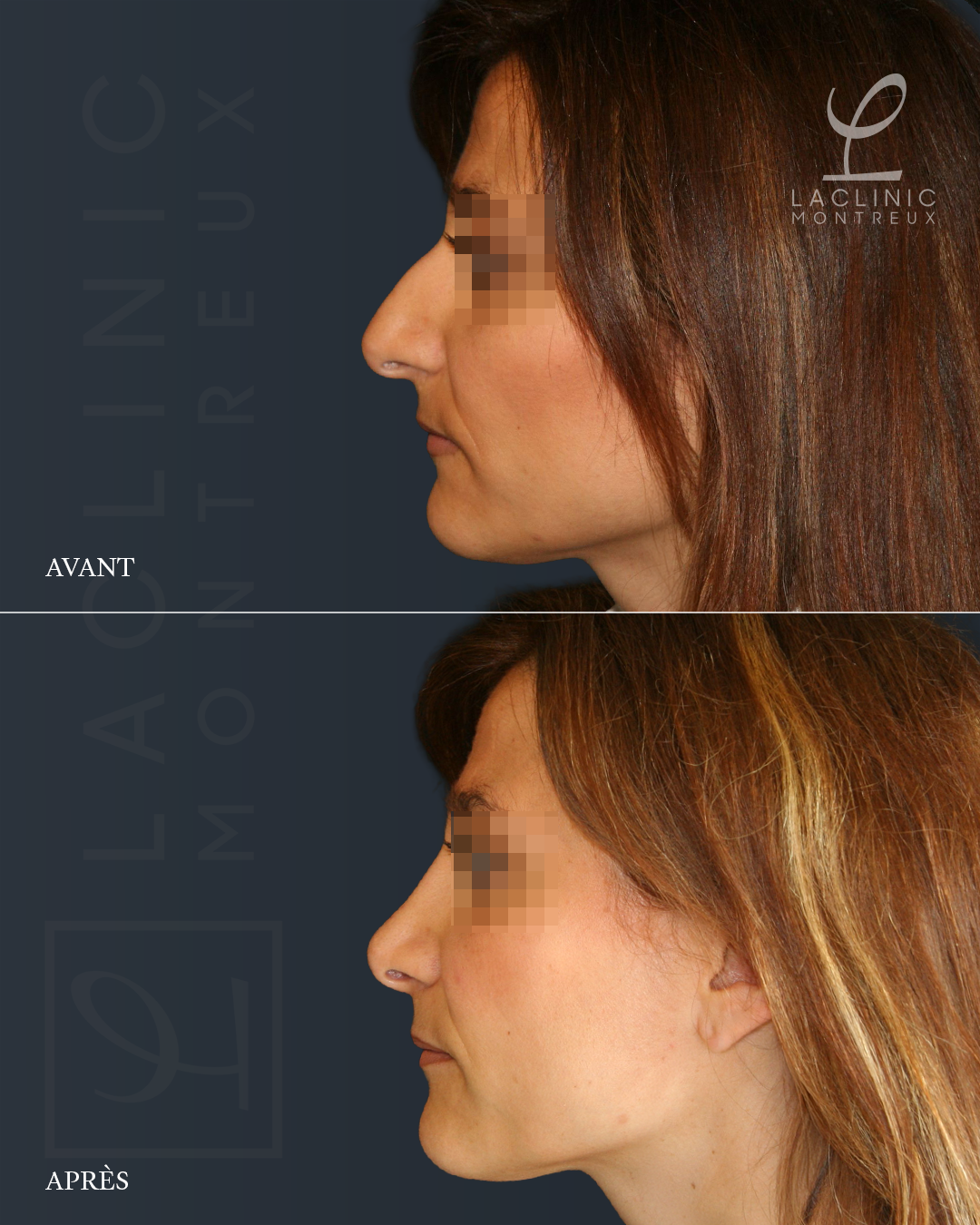 Avant-après rhinoplastie chirurgie esthétique du nez