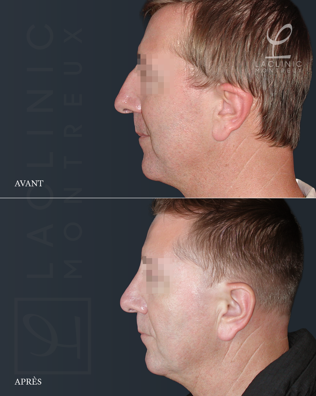 Avant-après rhinoplastie chirurgie esthétique du nez