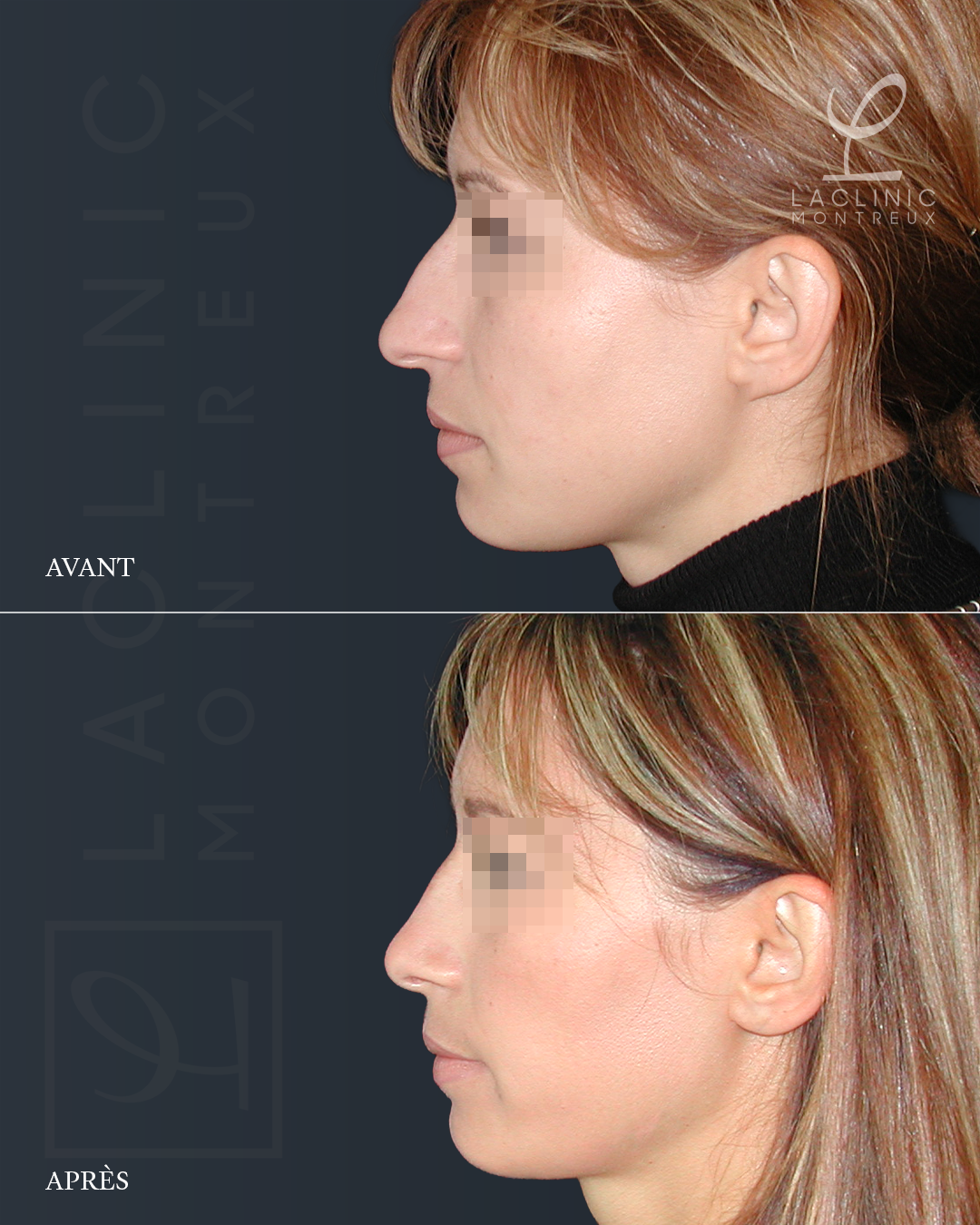 Avant-après rhinoplastie chirurgie esthétique du nez