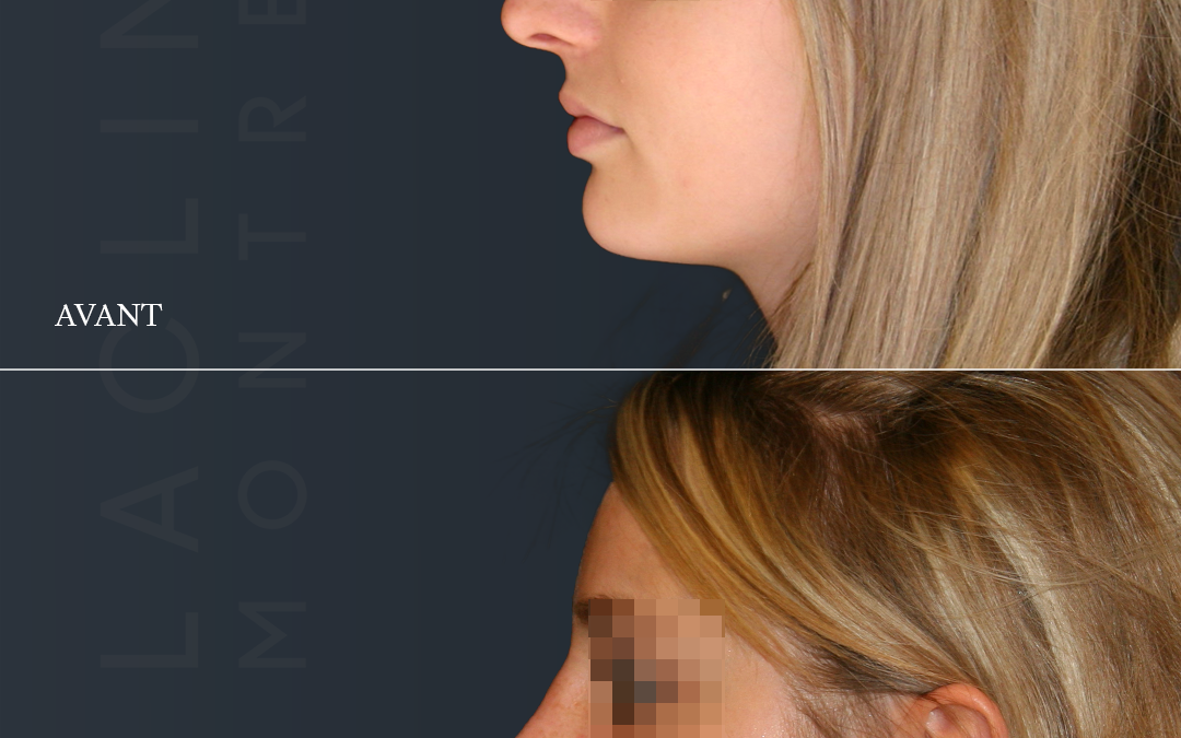 Rhinoplastie