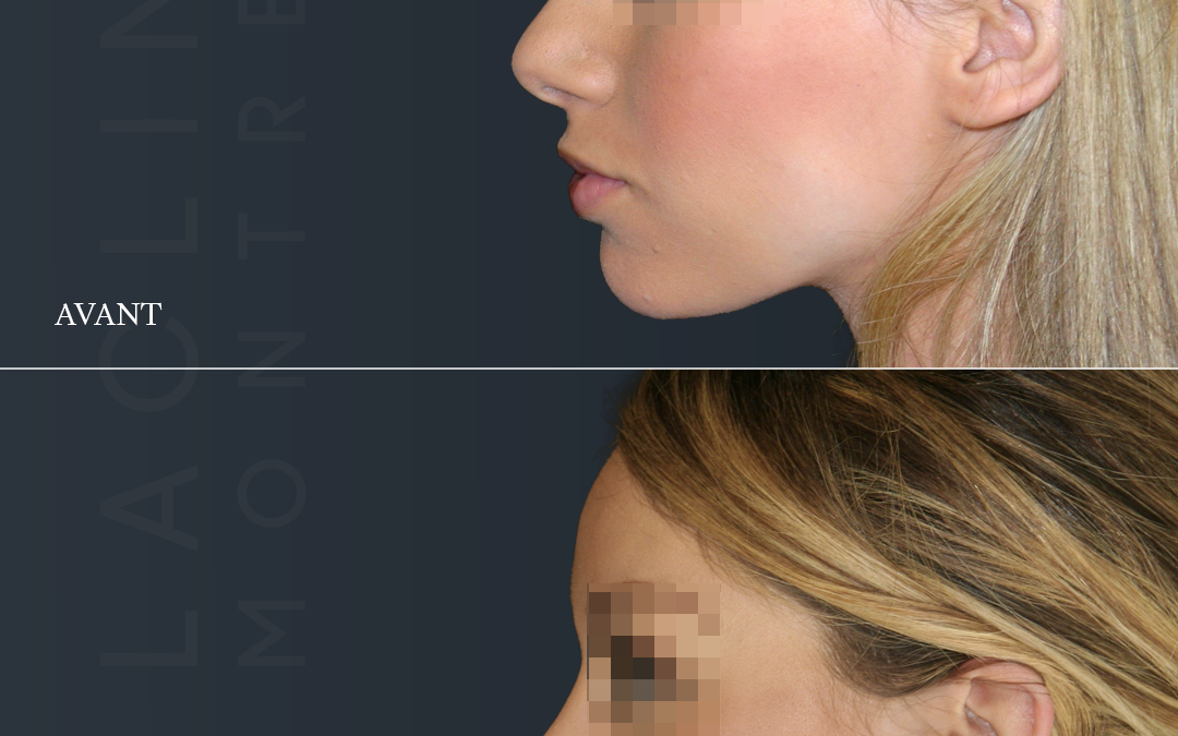 Rhinoplastie
