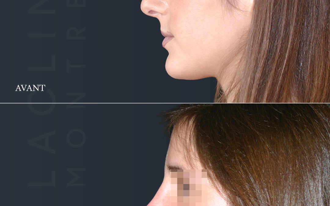 Rhinoplastie