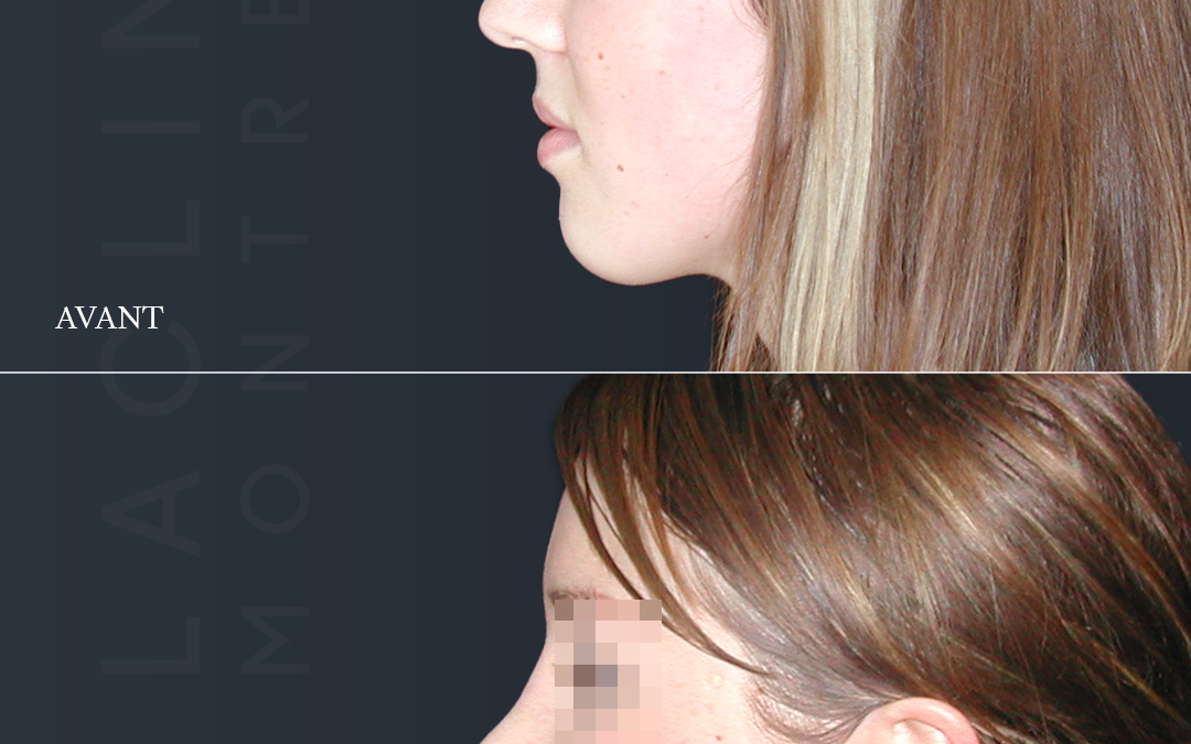 Rhinoplastie