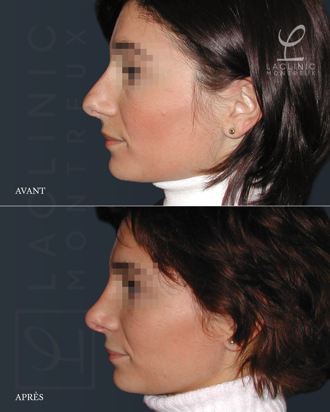 Avant-après rhinoplastie chirurgie esthétique du nez