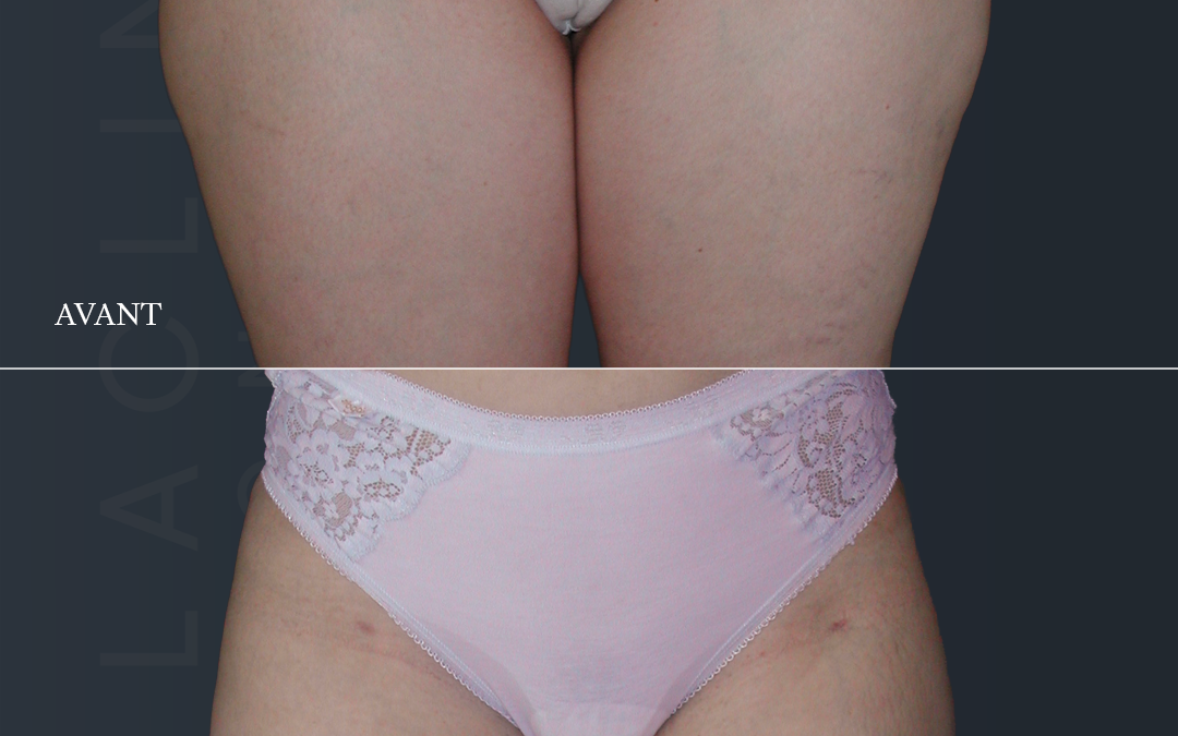 Lipoaspiration des fesses /culotte de cheval