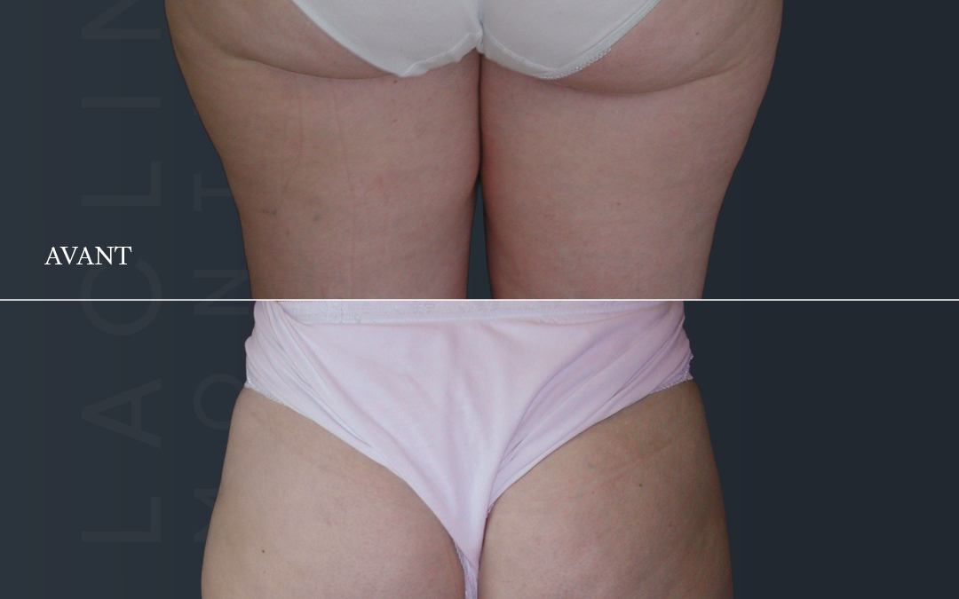 Lipoaspiration des fesses /culotte de cheval