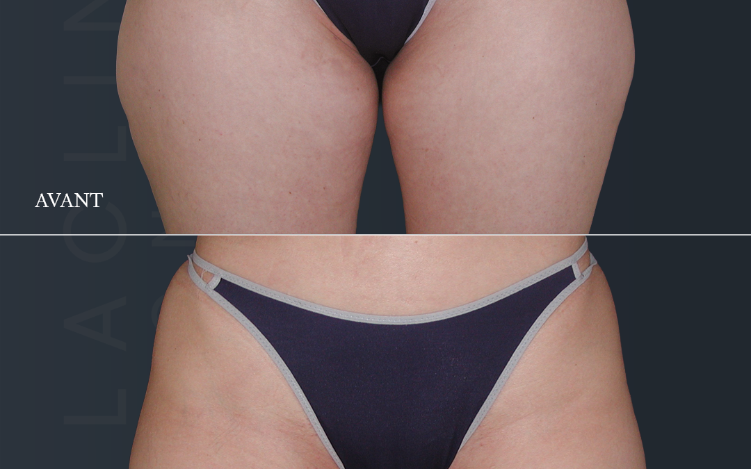 Lipoaspiration des fesses /culotte de cheval