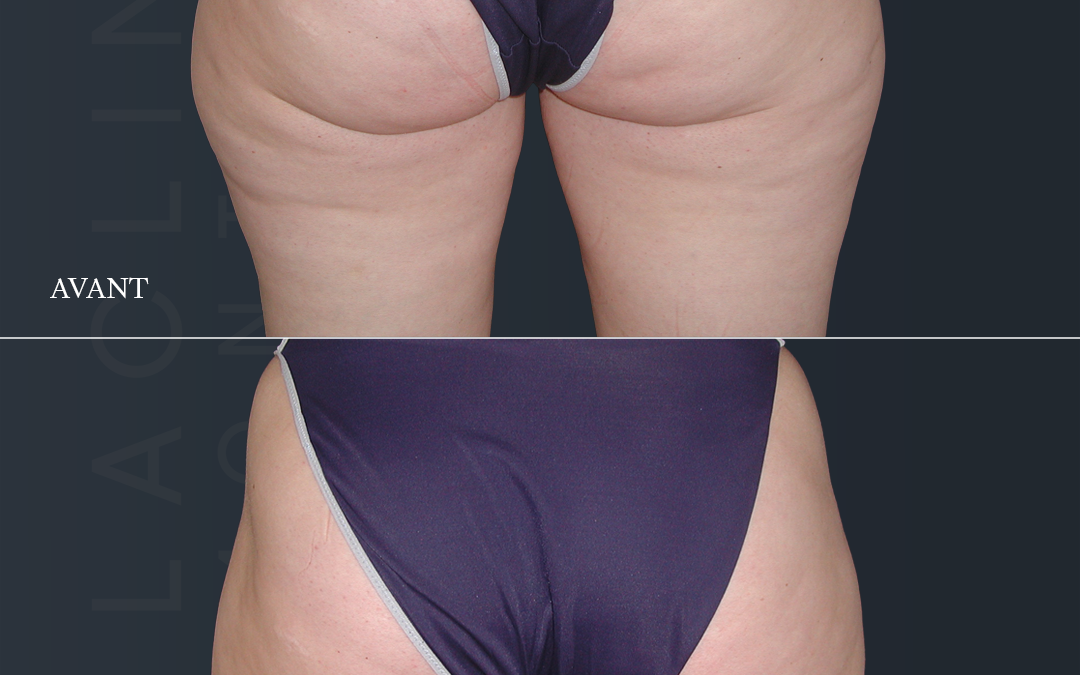 Lipoaspiration des fesses /culotte de cheval