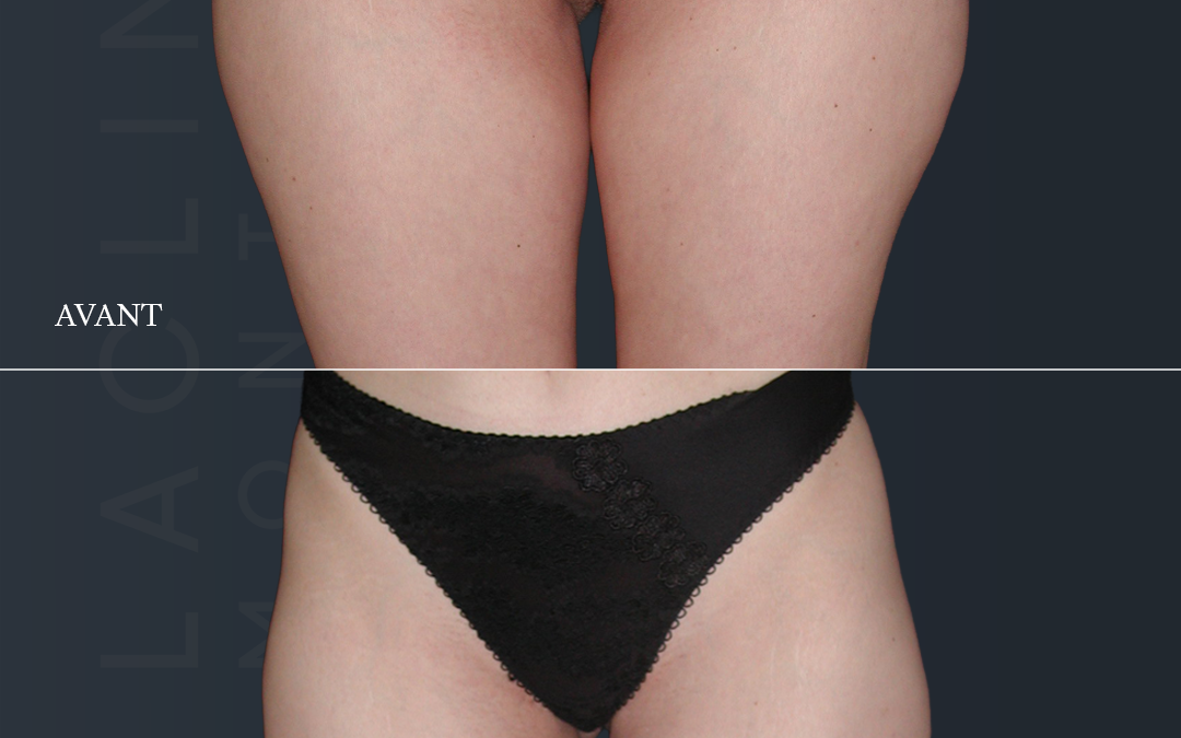 Lipoaspiration des fesses /culotte de cheval
