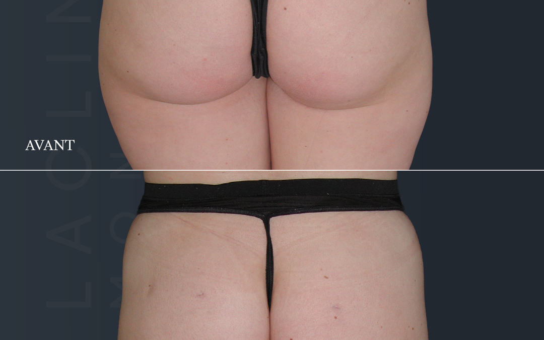Lipoaspiration des fesses /culotte de cheval