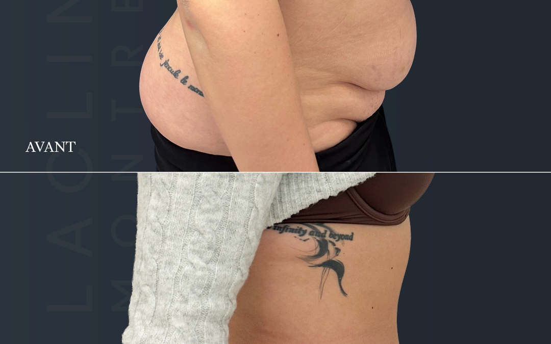 Bodylift