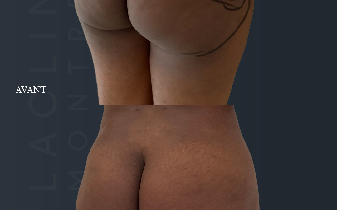 Lipofilling des fesses