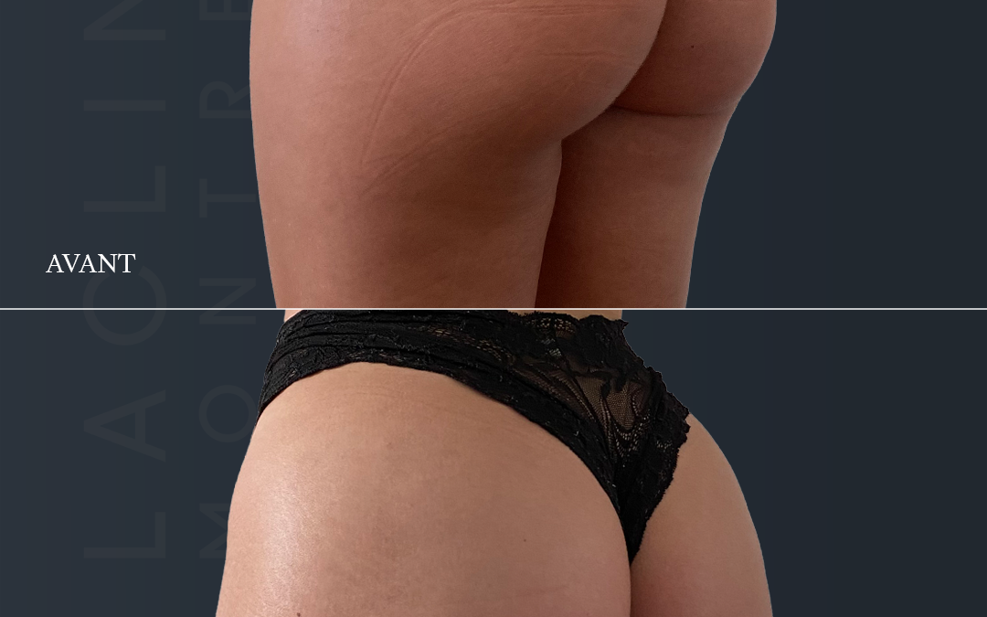 Lipofilling des fesses