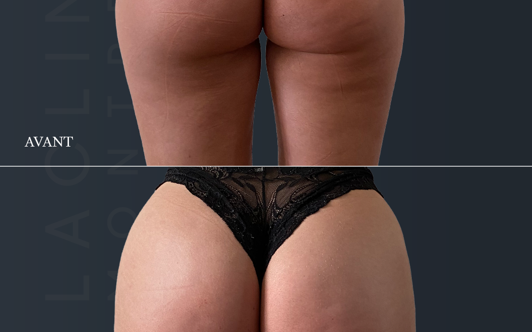 Lipofilling des fesses