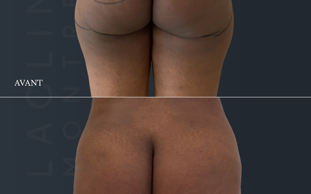Lipofilling des fesses