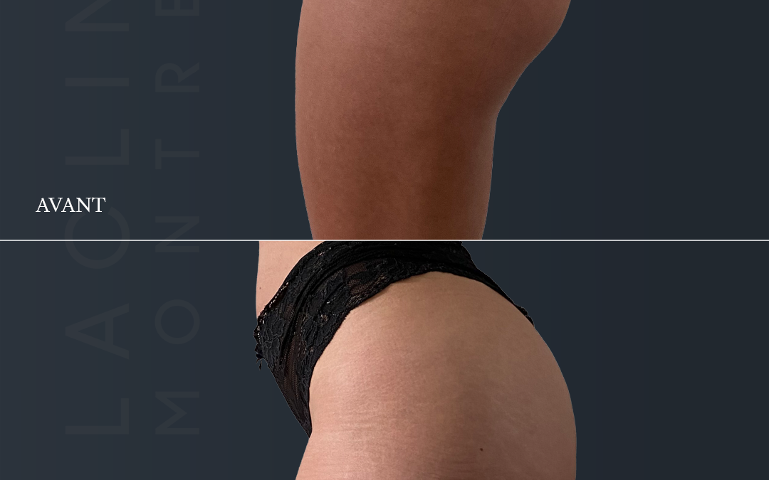 Lipofilling des fesses