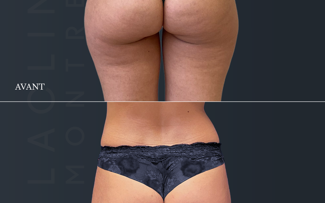 Liposuccion des fesses