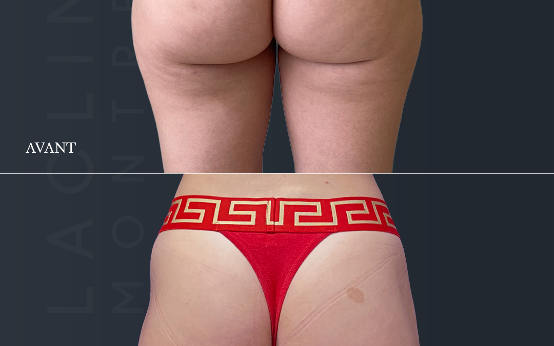 Liposuccion des fesses