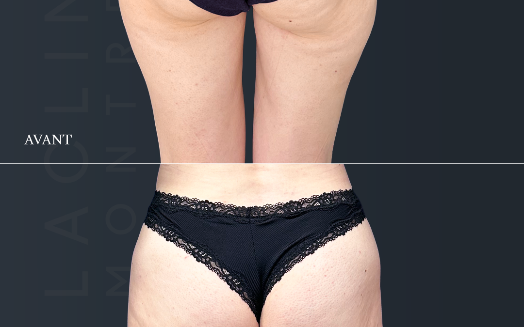 Liposuccion des fesses