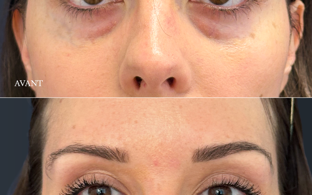 Filler acide hyaluronique cernes