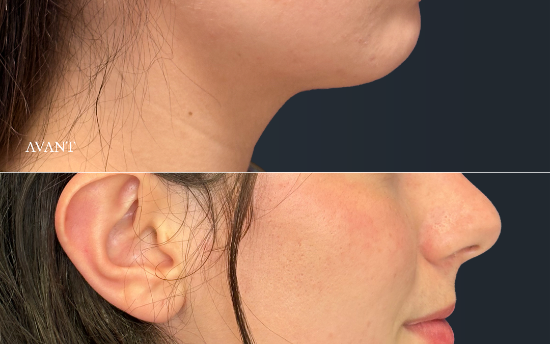 Filler acide hyaluronique cernes