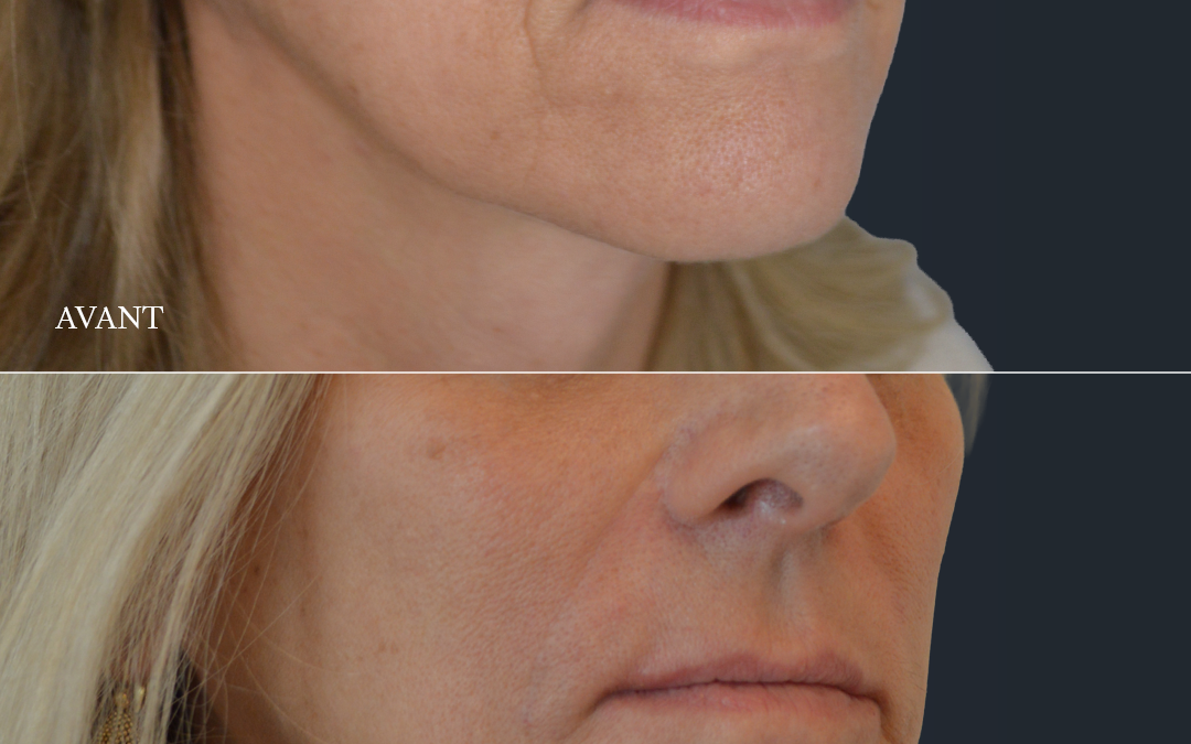 Filler acide hyaluronique sillons nasogéniens