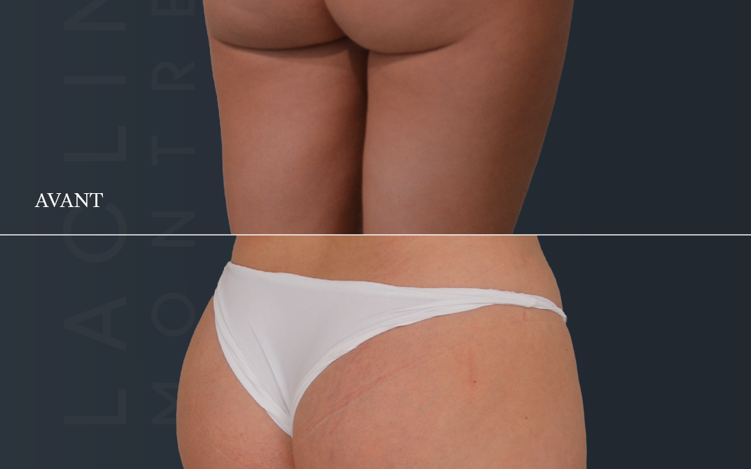 Prothèses de fesses – brasilian butt lift