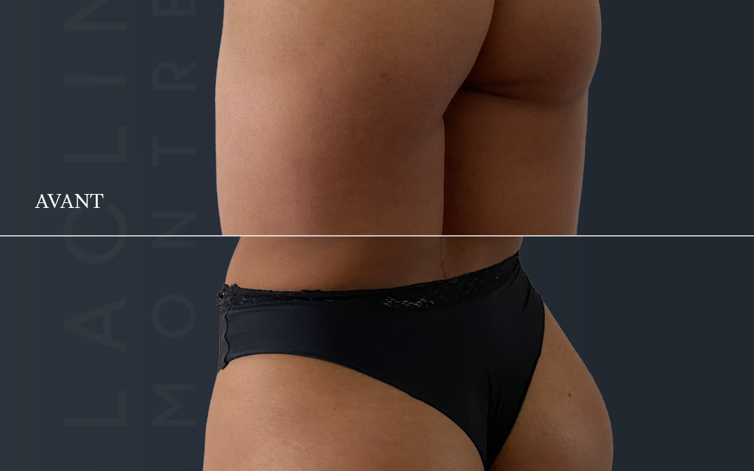 Prothèses de fesses – brasilian butt lift