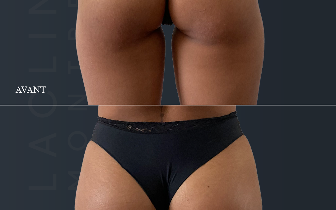 Prothèses de fesses – brasilian butt lift