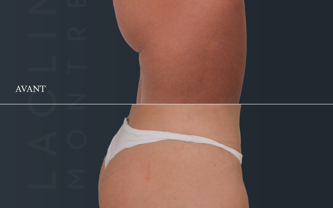 Prothèses de fesses – brasilian butt lift