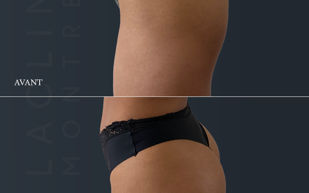 Prothèses de fesses – brasilian butt lift